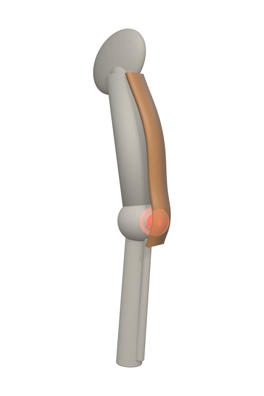 Diagrama de la cintilla iliotibial en la cara externa del muslo, con el punto de dolor en el cóndilo externo.